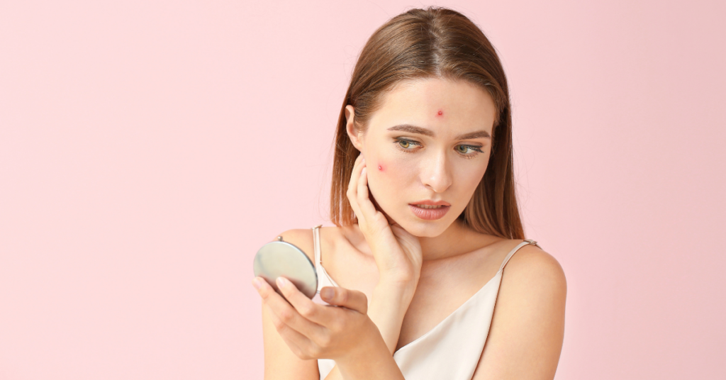 Acne Treatment & Skincare Routine: Causes, Symptoms & Expert Tips