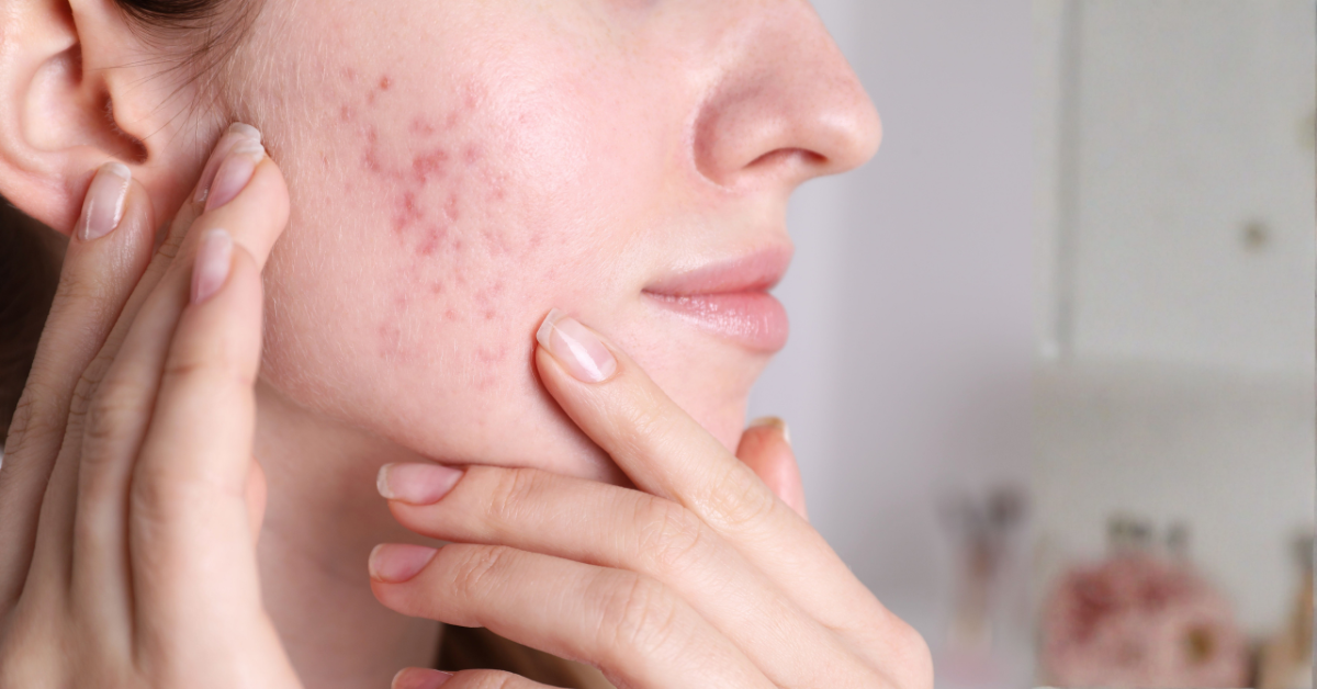 Why Are Your Acne Marks Not Going Away? Expert Dermatologist Insights