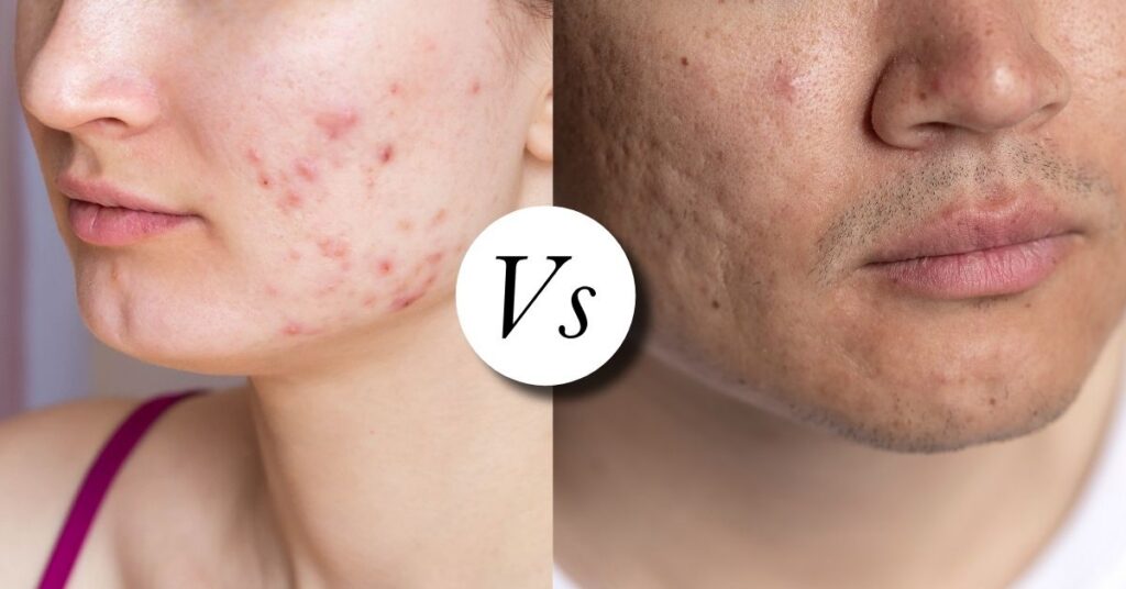 Acne Marks vs Acne Scars: What’s the Difference? Do Acne Marks Turn Into Scars? 