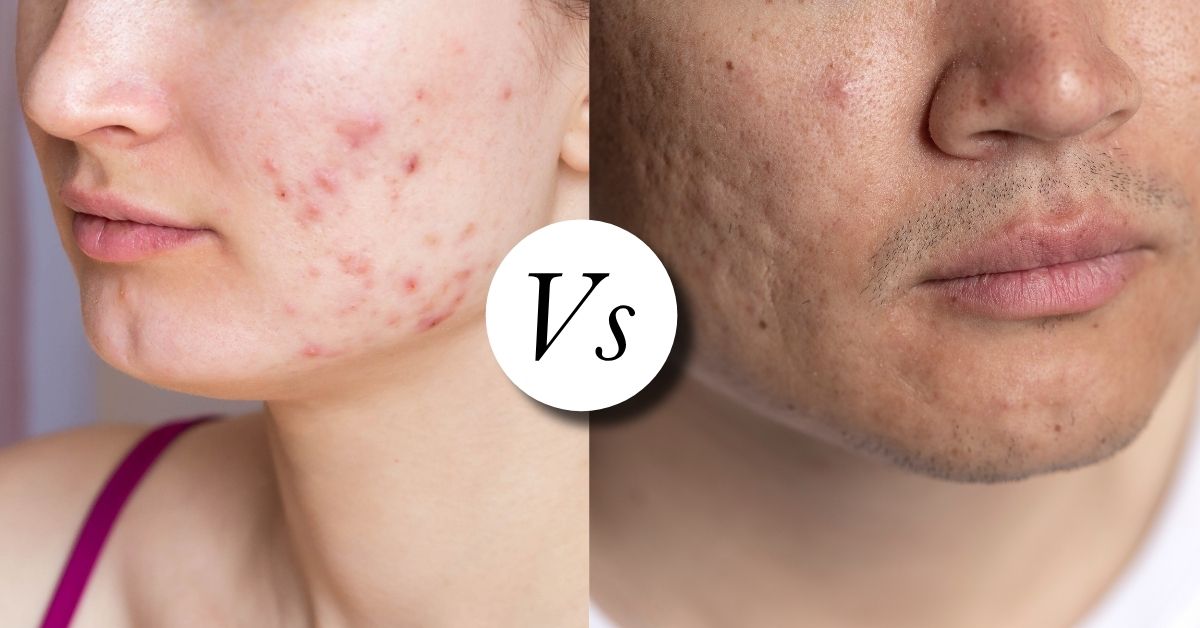 Acne Marks vs Acne Scars: What’s the Difference? Do Acne Marks Turn Into Scars? 