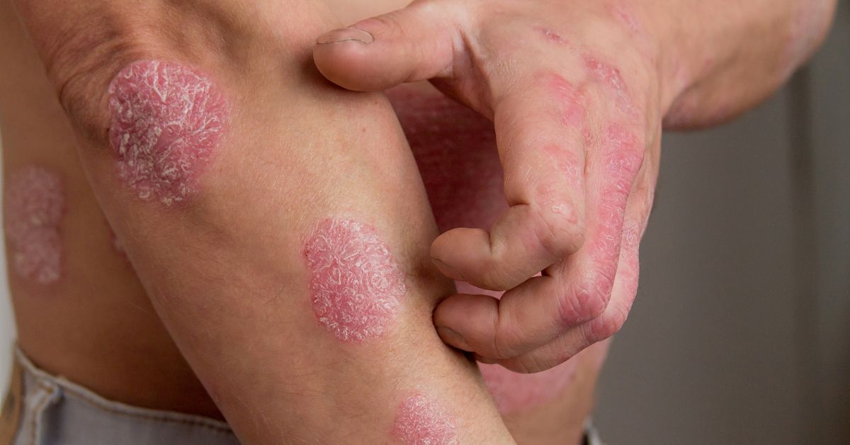 Is Psoriasis Contagious? Causes, Symptoms, Treatment & How It Spreads
